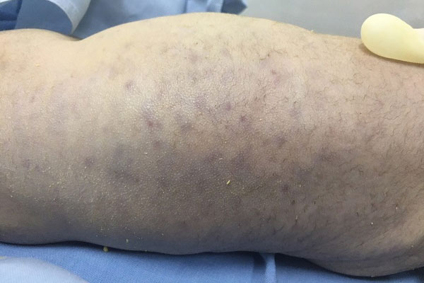 Trẻ sơ sinh tử vong nghi do nhiễm virus CMV gây ra các bệnh nhiễm trùng như thủy đậu-1