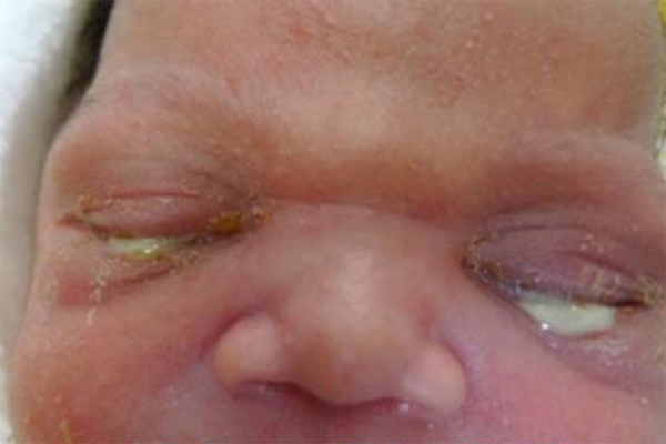 Bé gái Thái Bình vừa sinh đã mắc bệnh lậu-1