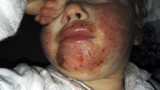 Hôn, nhai thức ăn cho trẻ: Không phải yêu thương, mà là gây tai họa khiến trẻ phải nhập viện-1