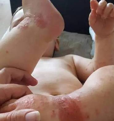 Hôn, nhai thức ăn cho trẻ: Không phải yêu thương, mà là gây tai họa khiến trẻ phải nhập viện-2