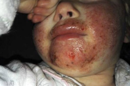 Hôn, nhai thức ăn cho trẻ: Không phải yêu thương, mà là gây tai họa khiến trẻ phải nhập viện