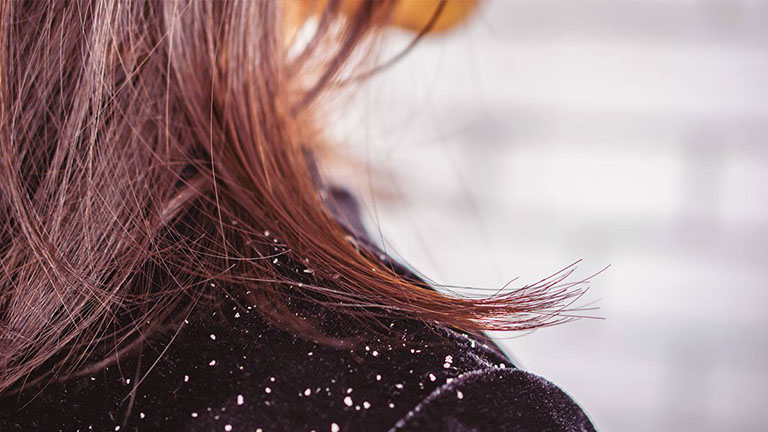 Mùa đông tóc rụng nhiều và có gàu? Áp dụng ngay cách gội đầu bằng nước muối để cải thiện, vừa rẻ lại hiệu quả-1