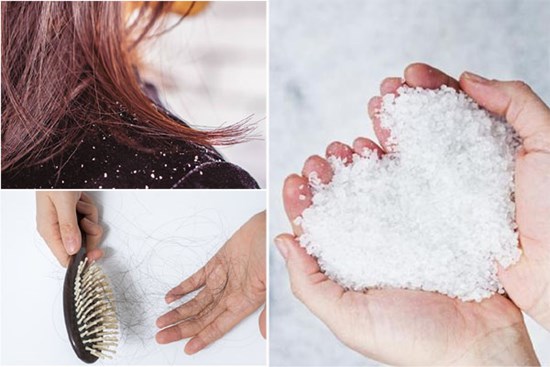 Mùa đông tóc rụng nhiều và có gàu? Áp dụng ngay cách gội đầu bằng nước muối để cải thiện, vừa rẻ lại hiệu quả