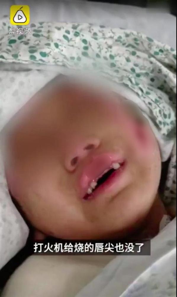 Địa ngục trần gian: Bé gái 6 tuổi bị mẹ ruột cùng bạn trai bạo hành dã man 3 tháng trời, bố đẻ gặp lại cũng không nhận ra con mình-2