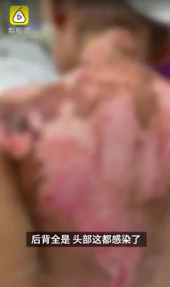 Địa ngục trần gian: Bé gái 6 tuổi bị mẹ ruột cùng bạn trai bạo hành dã man 3 tháng trời, bố đẻ gặp lại cũng không nhận ra con mình-3