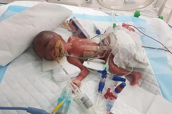 Dù chào đời chỉ nặng hơn 3 lạng - nhỏ hơn cả lon nước ngọt, nhưng hình ảnh hiện tại của bé gái khiến nhiều người phải kinh ngạc