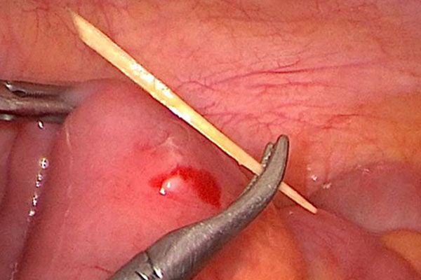 Đau bụng sau khi ăn phở, cô gái đi khám phát hiện thủng ruột non do nuốt phải tăm tre-1