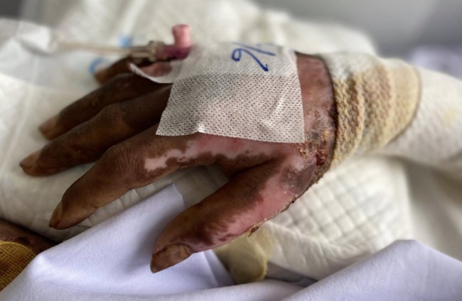 Đau lòng: Cha đón con đi học về rồi đóng cửa nhà châm lửa đốt, 2 cháu bé bị bỏng rất nặng-2