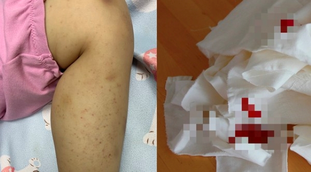 Bé gái 8 tuổi chảy máu mũi, xuất hiện ban đỏ và vết bầm tím, bác sĩ cảnh báo trường hợp nghiêm trọng có thể tử vong-1
