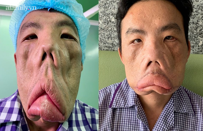 Căn bệnh của người đàn ông mặt quỷ đã được giải mã, giành giải thưởng tại cuộc thi y khoa ở Hoa Kỳ-2