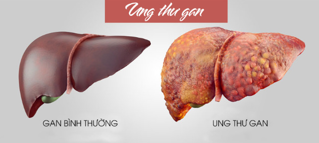 Cô gái 25 tuổi bất ngờ được chẩn đoán ung thư gan, bác sĩ lắc đầu: Lối sống của cô chính là chất xúc tác-1