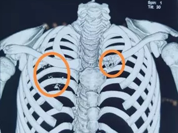 Bé trai 12 tuổi bị ung thư phổi giai đoạn cuối, nguyên nhân là do những thói quen xấu rất nhiều trẻ hiện nay đang mắc phải-3