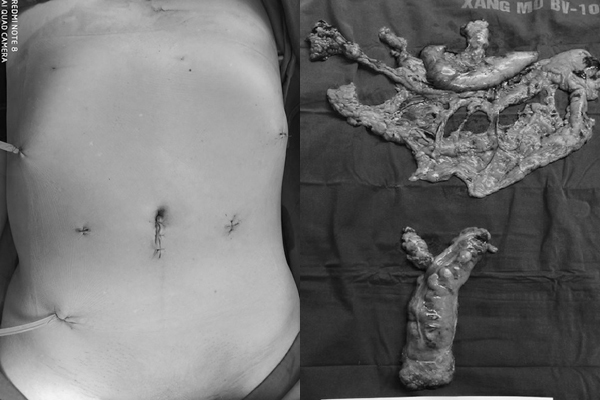 Đi ngoài ra máu, người đàn ông phát hiện mắc 2 ung thư hàng đầu-1