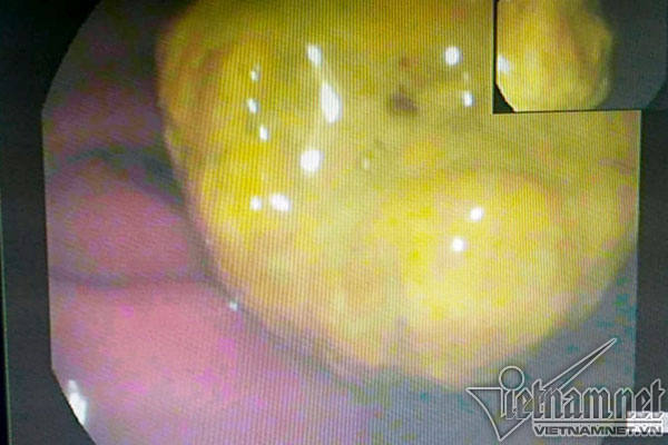 Uống nghệ mật ong sai cách, người phụ nữ Thái Nguyên nhập viện-1