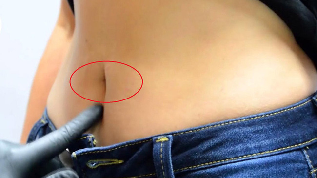 Thấy mụn xuất hiện ở chỗ này, người phụ nữ chần chừ đi khám, không ngờ tế bào ung thư di căn quá nhanh, tử vong sau 6 tháng điều trị-1