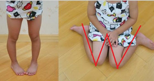 6 chi tiết ảnh hưởng lớn đến ngoại hình của trẻ nhưng hiếm khi cha mẹ nhận thấy, chẳng trách&nbsp;bé rất đẹp khi còn nhỏ nhưng lớn lên&nbsp;lại kém xinh-5