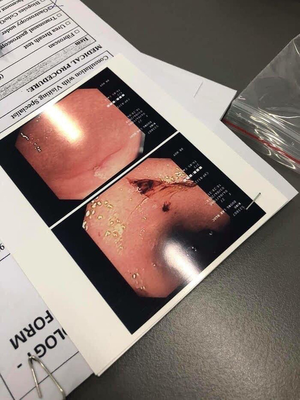 Netizen xót xa đào lại ảnh Lan Ngọc kiệt sức ở phim trường, nội soi dạ dày viêm loét đến chảy máu trước khi phát hiện ung thư-5