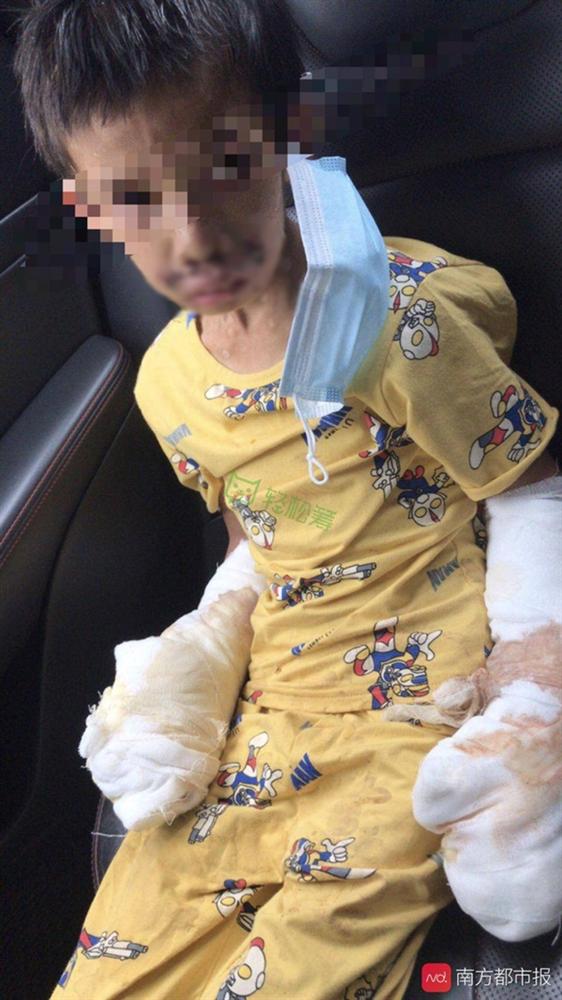 Bé trai 7 tuổi tàn phế vì bị bạo hành: Bố đâm tàn thuốc khắp người, mẹ dùng dao khứa vào chân, hình ảnh nạn nhân gây đau lòng-1