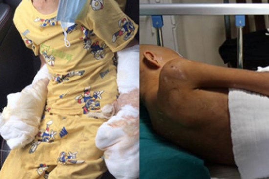 Bé trai 7 tuổi tàn phế vì bị bạo hành: Bố đâm tàn thuốc khắp người, mẹ dùng dao khứa vào chân, hình ảnh nạn nhân gây đau lòng