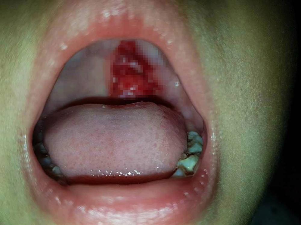 Cảnh báo: Uống trà sữa bằng ống hút cứng, bé gái gặp nạn gây xước vòm họng đau đớn-1