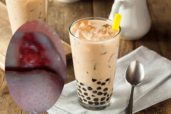 Cảnh báo: Uống trà sữa bằng ống hút cứng, bé gái gặp nạn gây xước vòm họng đau đớn