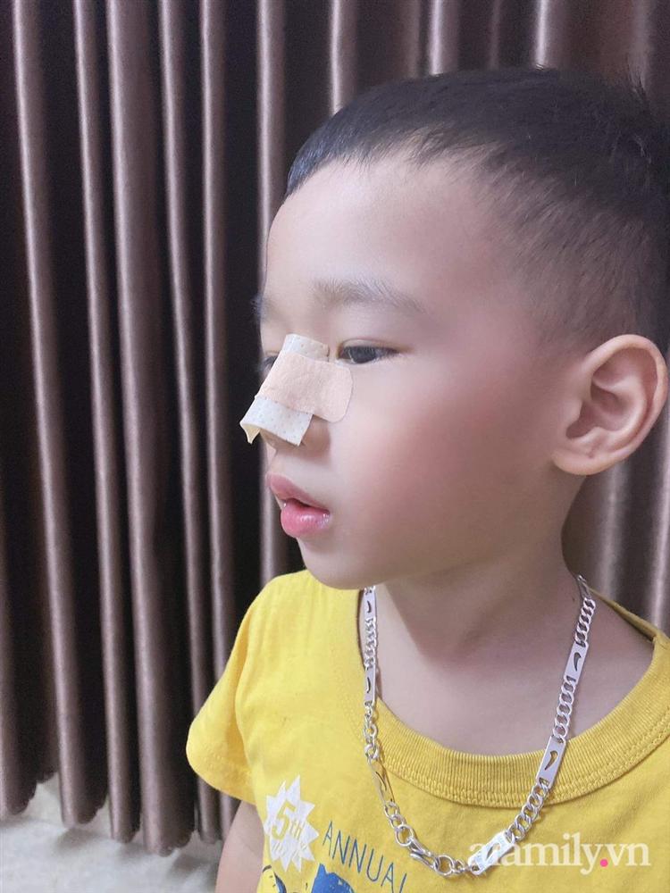 Thực hư hình ảnh bé trai 3 tuổi đã phẫu thuật nâng mũi kèm lời khẳng định của người mẹ: Xấu chỗ nào mẹ đập chỗ đó-2