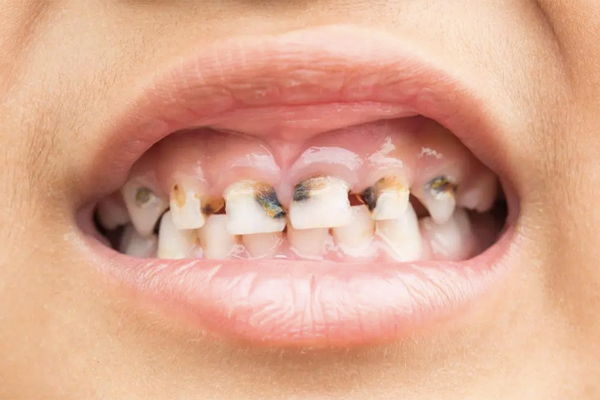 7 dấu hiệu cảnh báo cơ thể thiếu canxi nghiêm trọng, có thể tử vong-2