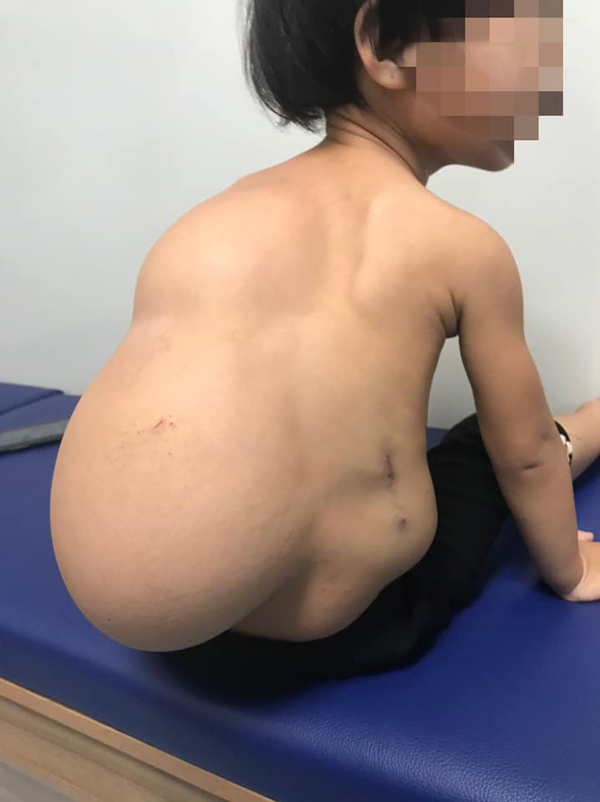 Bé gái 2 tuổi oằn mình cõng khối u lớn sau lưng, cột sống biến dạng-1