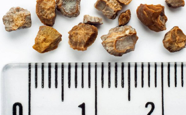 Bệnh sỏi tiết niệu - ‘hung thần’ âm thầm, không triệu chứng-1