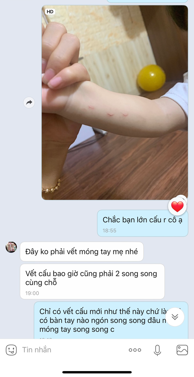 Bé mẫu giáo đi học về tay xuất hiện đầy vết bấm móng tay, nhà trường có bài giải thích khiến mẹ bức xúc vì sai sự thật?-2