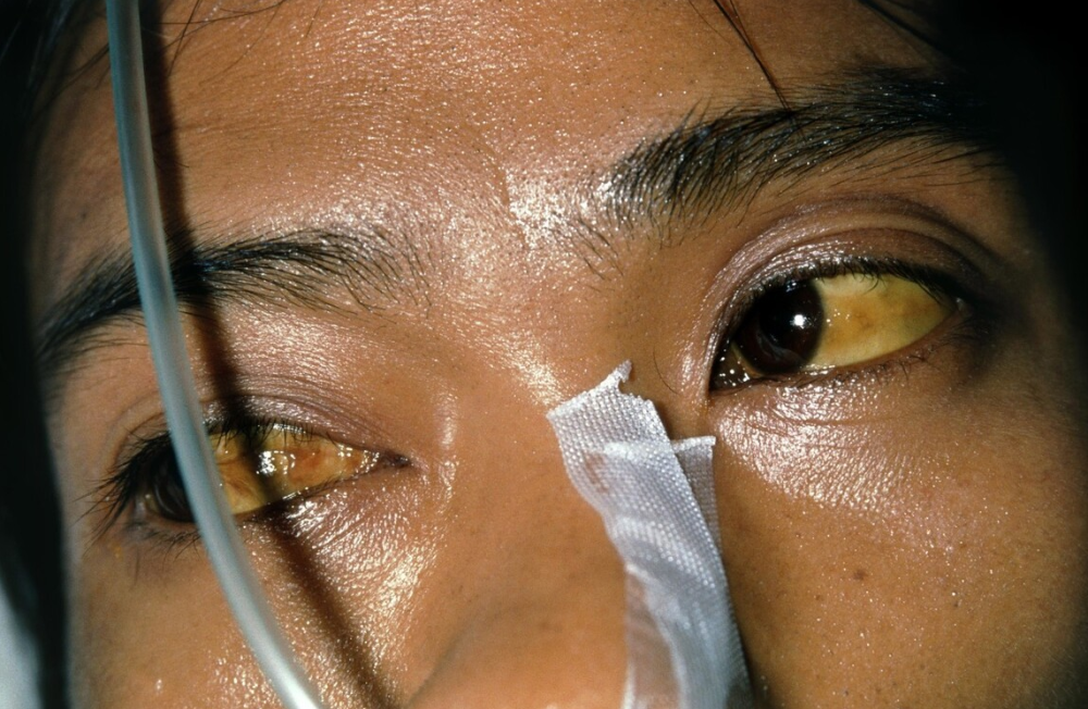 Cô gái mới 29 tuổi đã mắc bệnh ung thư gan, bác sĩ lắc đầu thở dài: Tối nào cũng ăn món này trước khi ngủ, sớm muộn bệnh cũng tìm tới-4