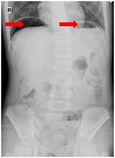 Thường xuyên chấm đồ ăn với tương ớt trong các bữa ăn, bé trai 11 tuổi bị thủng dạ dày-1
