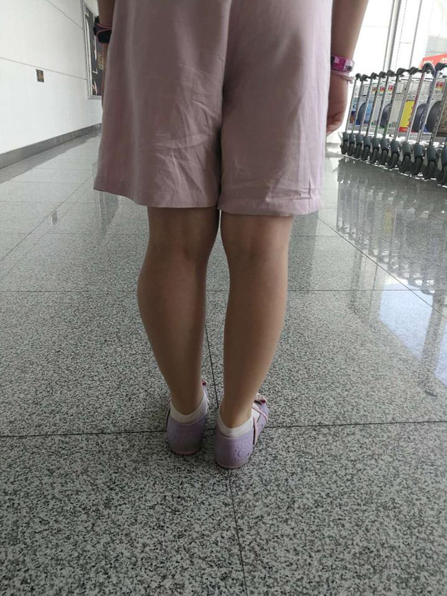 Thấy sự khác biệt rõ ràng này ở 2 chân của con, cha mẹ đau lòng khi bác sĩ nói con bị ung thư xương, việc phẫu thuật là một thách thức-2