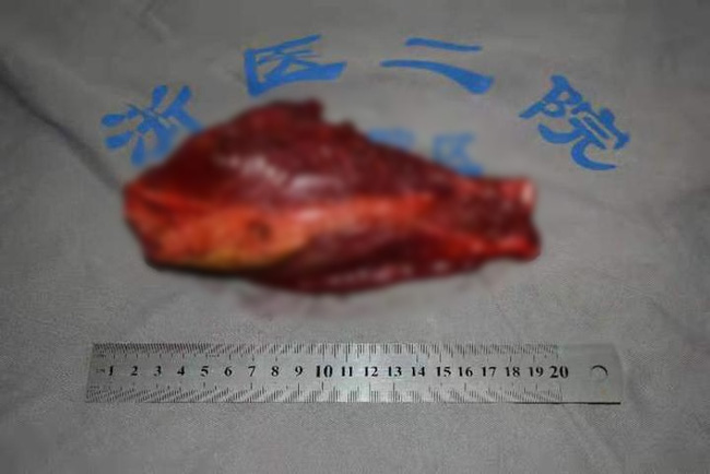 Thấy sự khác biệt rõ ràng này ở 2 chân của con, cha mẹ đau lòng khi bác sĩ nói con bị ung thư xương, việc phẫu thuật là một thách thức-4