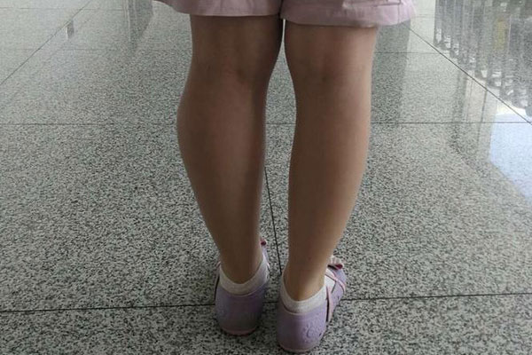 Cô gái 14 tuổi phải cắt cụt 2 chân vì ung thư xương, bác sĩ cảnh báo đây là căn bệnh nhiều người trẻ mắc phải trong độ tuổi dậy thì-4