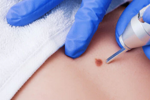 Dấu hiệu nhận biết nốt ruồi ung thư so với nốt ruồi thường-1