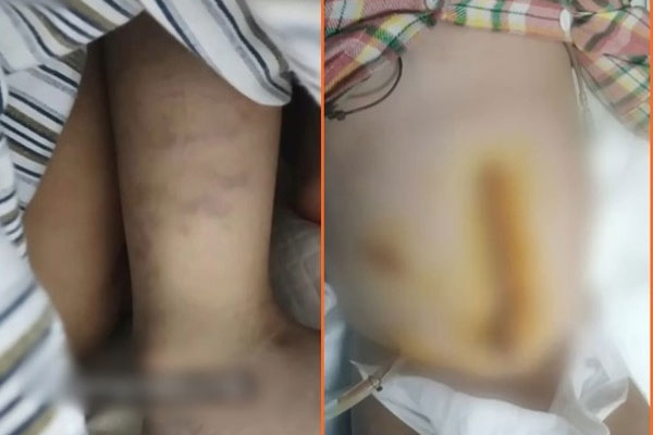 Được nhận nuôi chưa đầy 1 năm, bé gái bị bỏ bê và bạo hành đến mức thân tàn ma dại, ảnh trước và sau như 2 con người khác biệt-5
