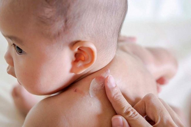 Bác sĩ da liễu cảnh báo bệnh về da rất dễ tái phát khi trời trở lạnh, dù trẻ hay già cũng đều khó tránh!-4