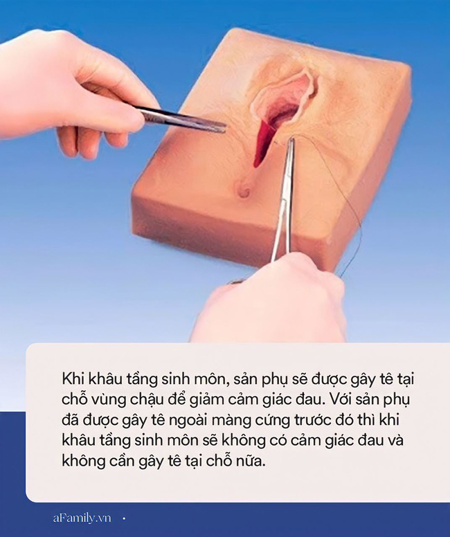 Khâu mũi nào biết mũi đấy” - lời nhận xét của chị em khi khâu tầng sinh môn và giải đáp của bác sĩ về việc có nên gây tê hay khâu sống”?-2