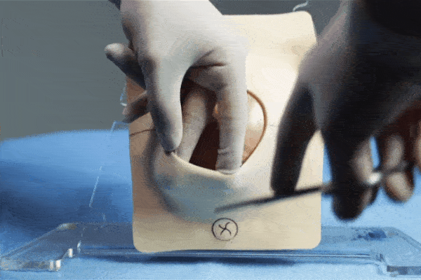 “Khâu mũi nào biết mũi đấy” - lời nhận xét của chị em khi khâu tầng sinh môn và giải đáp của bác sĩ về việc có nên gây tê hay “khâu sống”?