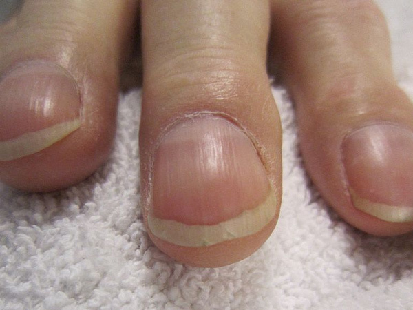 Năm triệu chứng của ung thư phổi rất nhiều người không biết-1