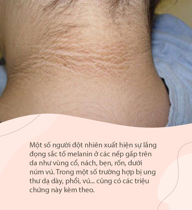 Nếu nhận thấy da có 4 màu sắc bất thường này rất có thể đó là tín hiệu của khối u ác tính mà bạn không nên chủ quan-3