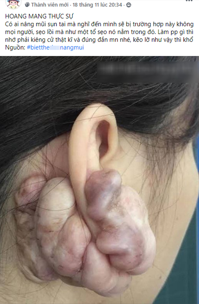 Hình ảnh sẹo đùn kín tai do nâng mũi bằng sụn tai gây sốc trên MXH: Có hay không việc sửa mũi đẹp xong khiến tai bị dị dạng?-1