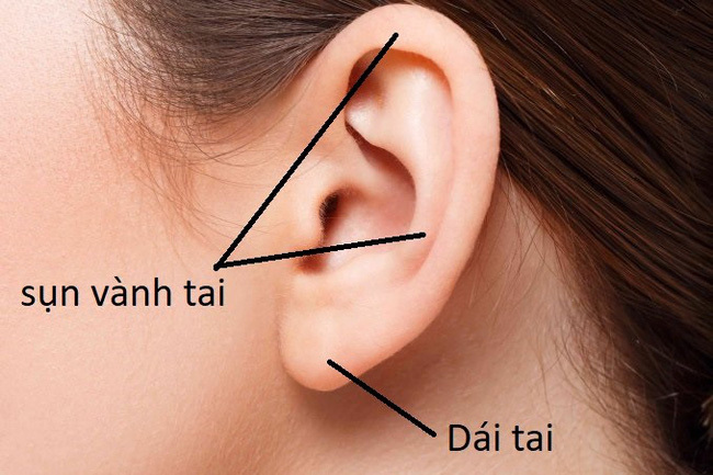 Hình ảnh sẹo đùn kín tai do nâng mũi bằng sụn tai gây sốc trên MXH: Có hay không việc sửa mũi đẹp xong khiến tai bị dị dạng?-4