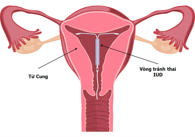 Tận mắt chứng kiến quy trình đặt vòng tránh thai mới thấy quá thương các mẹ-1