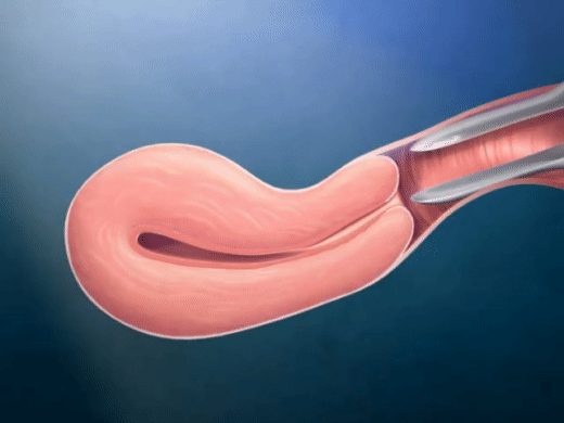 Tận mắt chứng kiến quy trình đặt vòng tránh thai mới thấy quá thương các mẹ-4