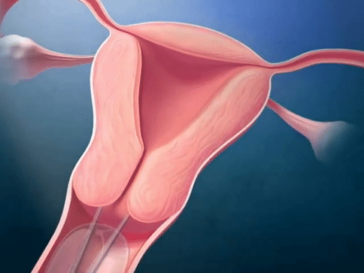 Tận mắt chứng kiến quy trình đặt vòng tránh thai mới thấy quá thương các mẹ-5