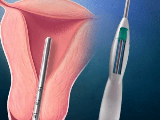 Tận mắt chứng kiến quy trình đặt vòng tránh thai mới thấy quá thương các mẹ-6