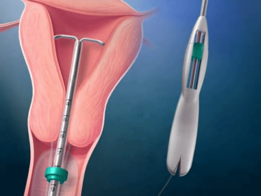 Tận mắt chứng kiến quy trình đặt vòng tránh thai mới thấy quá thương các mẹ-7