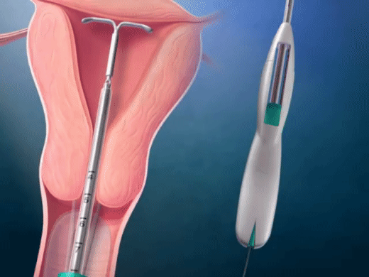 Tận mắt chứng kiến quy trình đặt vòng tránh thai mới thấy quá thương các mẹ-8